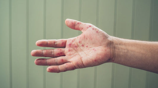 Measles Outbrea