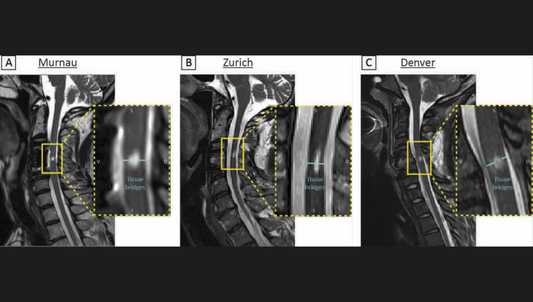 Single MRI Scans Predict Aging Rate, Disease Risk
